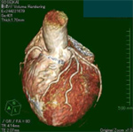 心臓ＭＲ三次元画像
