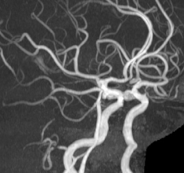 MRAにおいて、両側の内頸動脈後交通動脈分岐部に脳動脈瘤が認められます。