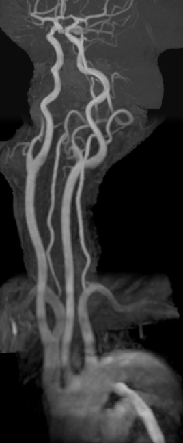 MRAは、大動脈弓部から頭蓋内の血管まで描出することができます。