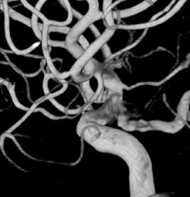 脳血管造影3D画像