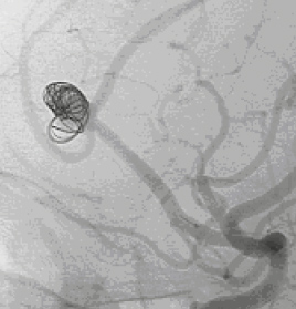 2本目のコイルが脳動脈瘤内に充填された直後の脳血管造影写真。
