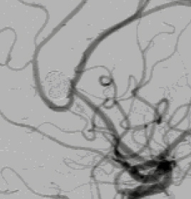3本目のコイルが脳動脈瘤内に誘導された直後の脳血管造影写真。