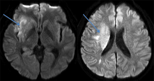 搬入時に撮影された頭部MRI-DWI(拡散強調画像)