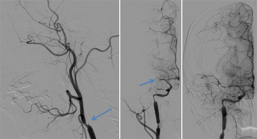 緊急脳血管造影とPTAにより再開通を果たした内頸動脈と中大脳動脈(矢印)