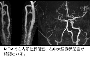 主幹動脈閉塞の超急性期CT