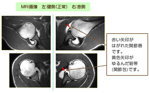 MRI画像　左：健側(正常)　右：患側