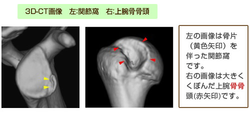 ３D-CT画像　左：関節窩　右：上腕骨骨頭