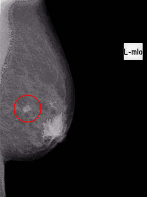 腫瘍画像（左乳房）
