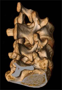 脊椎３Ｄ画像　脊椎分離症例
